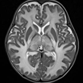 T2-weighted axial image showed hyperintense areas involving subcortical and periventricular white matter, bilateral thalamus,