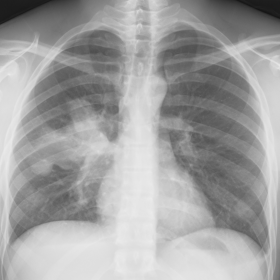 Posteroanterior chest radiograph shows an opacity with lobulated contours in the right mid zone (para-hilar).