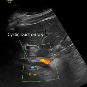 Extra hepatic duct dilatation seen on the ultrasound scan was actually the dilated cystic duct not dilated common bile duct, 