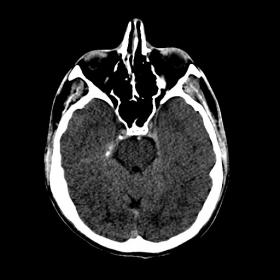 Unenhanced CT showing hyperdensity of the distal segment of the basilar artery.
