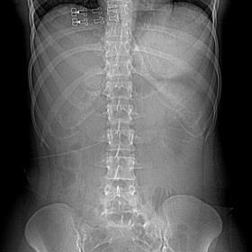 The plain X-ray abdomen showed no significant findings except for gas filled bowel loops.