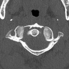 Axial CT demonstrating the fracture of the right posterior atlas arch and the splaying of lateral masses.