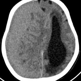 Plain axial cranial CT taken at the level of the lateral ventricles showed a predominantly isodense subdural haemorrhage alon