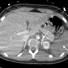 Selected axial slice from a contrast-enhanced CT of the abdomen demonstrating diffuse splenic hypoattenuation (solid arrow) a