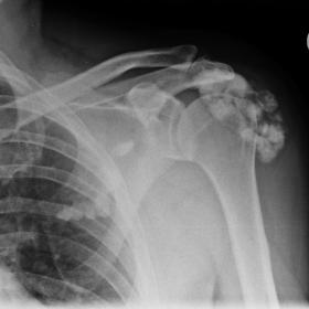 AP radiograph of the left shoulder showing extensive heterotopic soft tissue ossification projected over the left humerus and