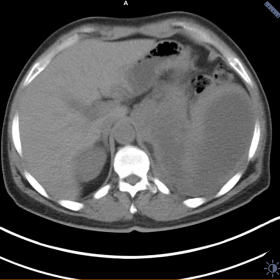 The abdominal CT image showing a large cystic mass involving the body, the tail of pancreas and the spleen.