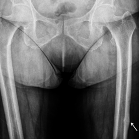 Anteroposterior (a) and lateral (b) radiographs of the left femur and hip joint show an incomplete, lucent fracture line (arr