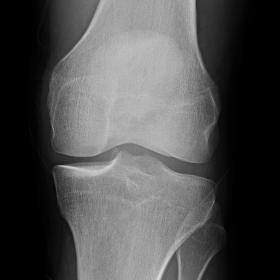 Conventional radiograph of the left knee, frontal view. There is a calcium-density structure projected over the posteromedial