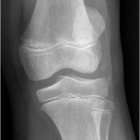 AP radiograph showing laterally dislocated patella.