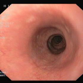 Upper gastrointestinal endoscopy revealed an oesophageal tortuosity.