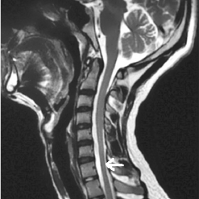 Neutral sagittal T2-weighted image shows mild to moderate cord flattening
