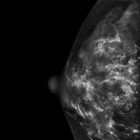 Mammograms of the right breast. The CC (1a) and MLO (1b) views show a dense breast with multiple scattered linear and round o