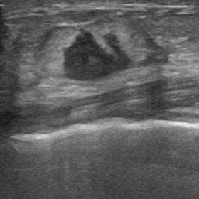 Ultrasound image showing a vertically oriented, irregular, hypoechoic mass with indistinct margins and with no posterior acou