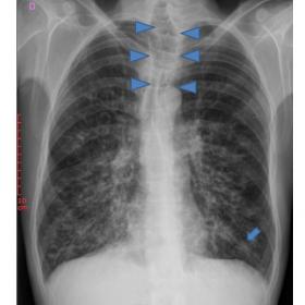 Chest radiography, posteroanterior view, shows tracheomegaly (arrowheads), multiple ill-defined opacities predominantly in th