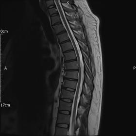 Sagittal T2-weighted MRI thoracic spine demonstrating focal ventral distortion of the thoracic cord with focal high-signal wi