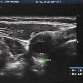 Doppler ultrasonography of the carotid arteries showed abnormal, hypoechoic, with scattered hyperechoic foci, fusiform, eccen