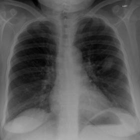 Chest radiograph demonstrating a focal pulmonary nodule in the left-middle lung zone, initially   assumed to represent a prim