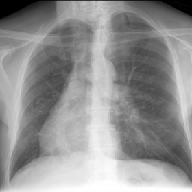 Chest X-ray showing a vertical tubular structure, with crescent morphology in the right hemithorax, posterior to the cardiac 