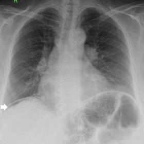 Showing free air under the right hemidiaphragm (white arrow); pneumoperitoneum with suspected perforated viscus