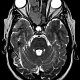T2-weighted axial image showing hypointense lesion in right nasal cavity and right frontal and ethmoidal sinus extending post