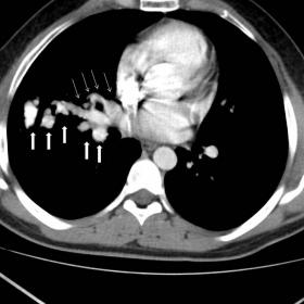 Axial image with mediastinal window of chest CT shows tortuous tubular mass extending from the right pulmonary hilum to perip