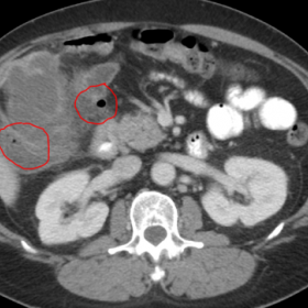 CT in portal venous phase showed an inflammation, ill-defined fluid collections adjacent to the GB and anterior to the liver 