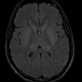 FLAIR-axial image at the level of basal ganglion shows patch areas of hyperintensity involving bilateral basal ganglion and t