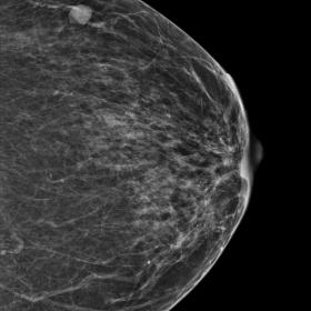 Left-breast mammogram CC and MLO showed: An oval shape equal density circumscribed mass in the upper-outer quadrant