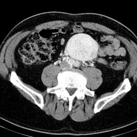 An avid contrast-enhancing mass is seen at the abdominal retroperitoneum causing slight compression of the aorta. It is a wel