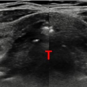 Transversal US of the neck shows focal dilatation of both thyroid laminae with hypoechogenic center (arrows). Trachea (T)