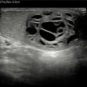 Multicystic lesion occupying the middle and distal third of the left testis.