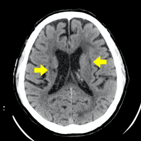 Axial non-enhanced CT at the level of the corona radiata shows chronic lacunar infarcts in the cerebral deep white matter and