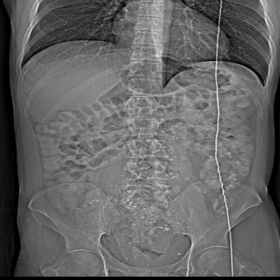 CT topogram – showing multiple small round calcified images in the lower quadrants of the abdomen, compatible with phleboli