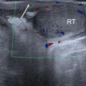 Transverse ultrasound showing right-testicular heterogeneous echogenicity (RT) and ipsilateral scrotal wall-thickening (arrow