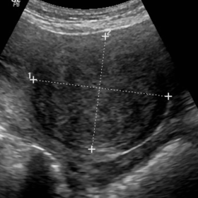 Ultrasound of pelvis shows a well-defined hypoechoic lesion in the vaginal region indenting upon the anterior cervical lip.
