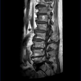 Preoperative MRI showing multilevel spinal canal stenosis. A: sagittal T1-weighted sequence; B: sagittal T2-weighted sequence