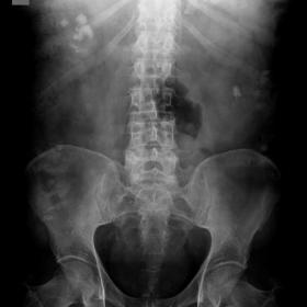 X-ray abdomen and pelvis (KUB) shows a renal stone in the lower calyces of the left kidney and multiple stones in the right e