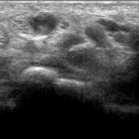 Ultrasound imaging showing a persistent median artery.