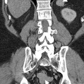 Non-contrast abdominal CT scan