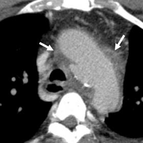 Axial (1a) and sagittal (1b) contrast-enhanced CT scan images show a saccular pseudoaneurysm in the aortic arch (measuring 4 