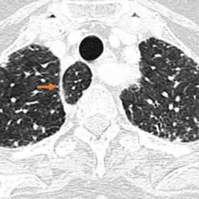 Axial chest HRCT at the apical level (A), showing the azygos vein lobe and respective accessory fissure (arrow); mid-lung lev