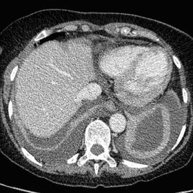 CT-thorax-abdomen, showing a well-distinctive hypodense aspect of the LV endocardium. There is bilateral pleural effusion