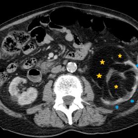 Abdominal CT with IV contrast (axial). Left kidney is enlarged due to the proliferation of adipose tissue in the renal sinus 
