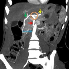 Contrast-enhanced CT - MIP thick slab in the coronal plane showing the coeliacomesenteric trunk (orange circle) that trifurca
