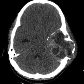 Multi-slice CT without intravenous contrast brain window - Large, expansile, lytic mass lesion involving left parietal and te