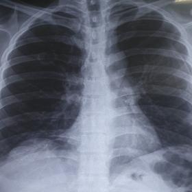 Chest X-Ray PA view showing bilateral pneumothorax (left > right) with single cavitary lesion in right middle zone.