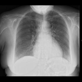 Chest X-ray at admission showed diffuse reticular pattern with small opacities in both basal regions