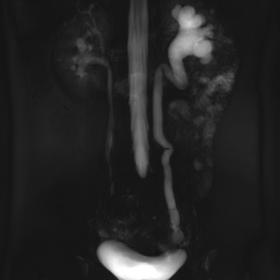 Maximum-intensity-projection of the magnetic resonance urography. Note the left hydronephrosis and hydroureter with tortuous 