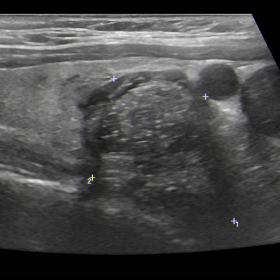 Ultrasound of the thyroid reveals a dominant nodule in the lower third of the right lobe, predominantly solid, heterogeneous 