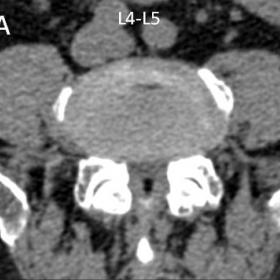 Lumbar spine CT. Axial (a, b) and sagittal reformatted (c) images demonstrate osteoporotic vertebral fractures at L1 and L5, 